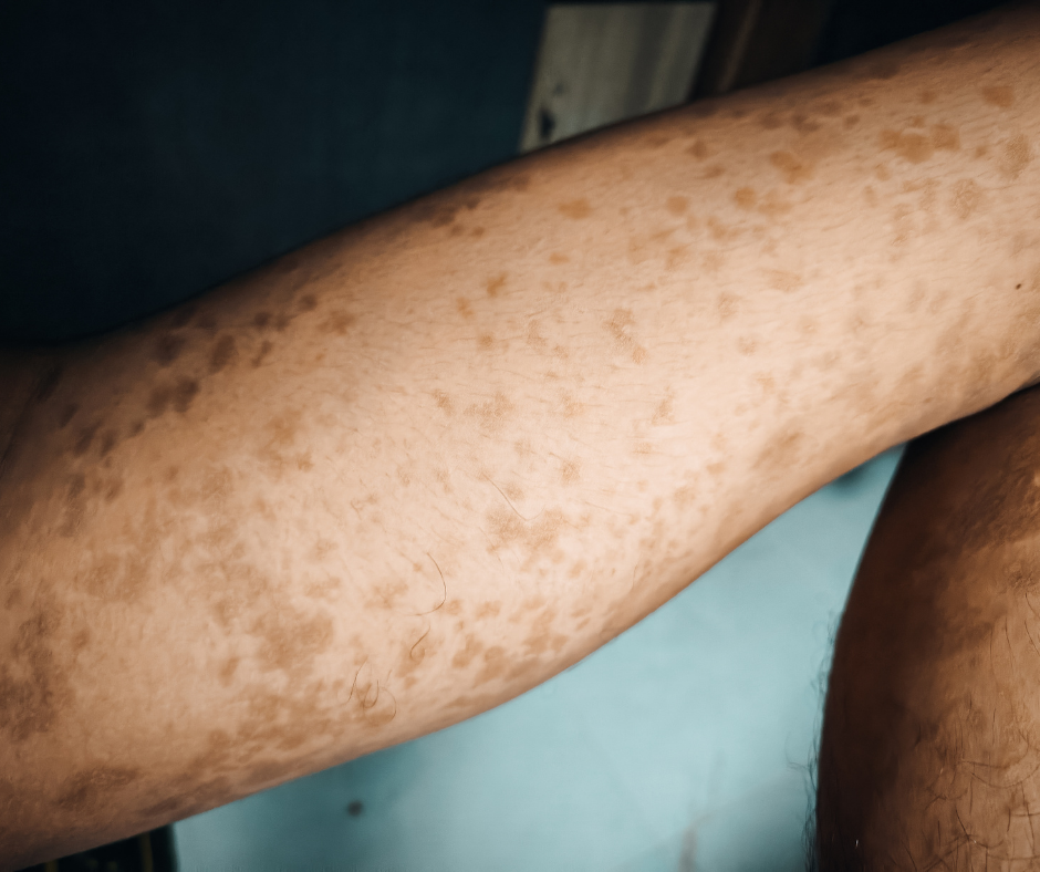 Measles rash on a child with darker skin.