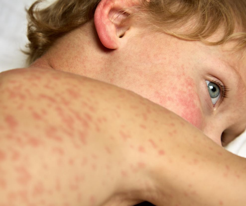 Measles rash on a child with light skin.