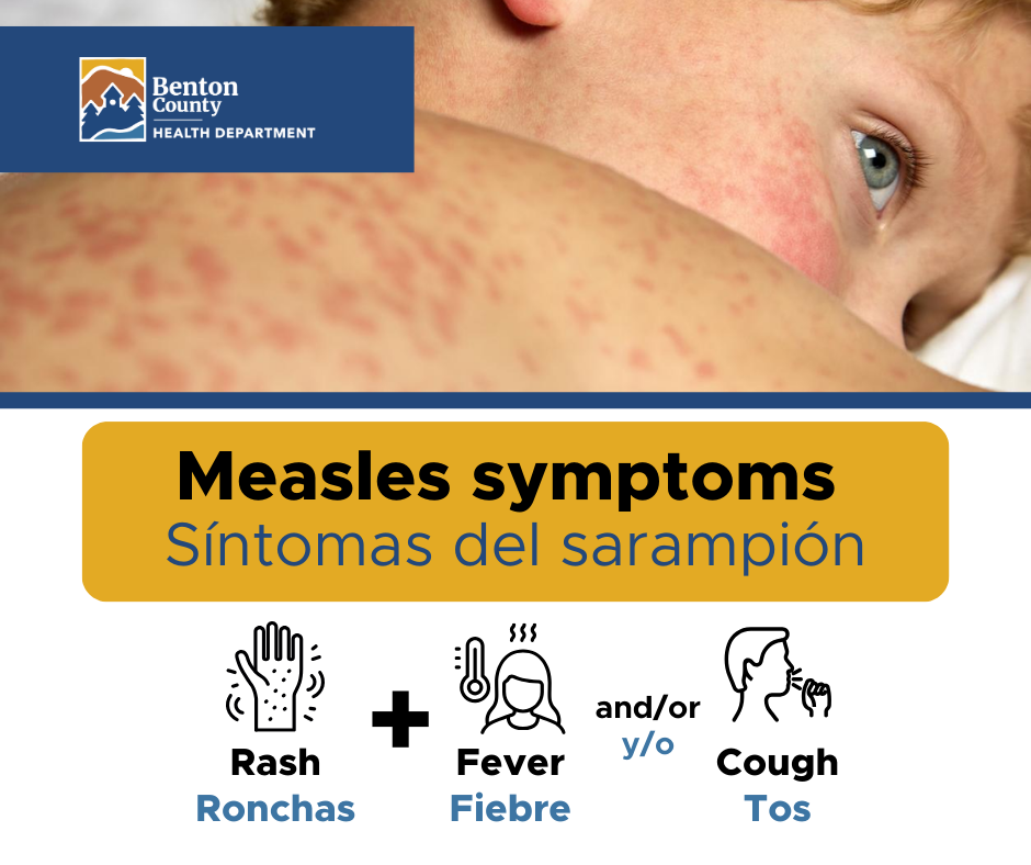 A child with a measles rash and illustrations of measles symptoms including rash, fever, and cough.