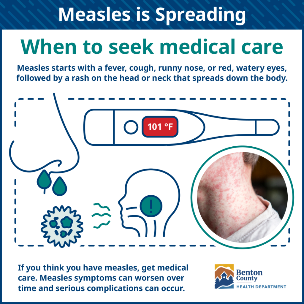 Illustration showing measles symptoms: fever over 101°F, cough, runny nose, red watery eyes, and a spreading rash on the neck and body.